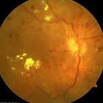 proliferativna retinopatija sa makulopatijom