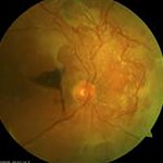 teška proliferativna retinopatija