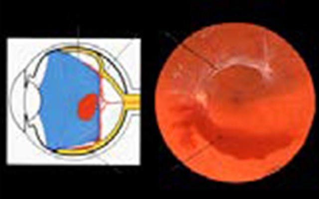 Vitreo retinopatia diabetica
